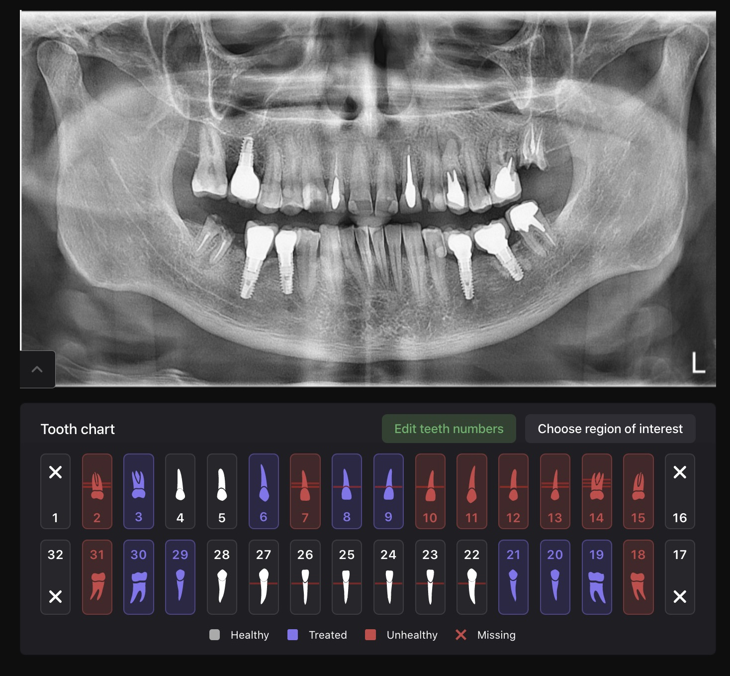 Panoramic radiograph OPG