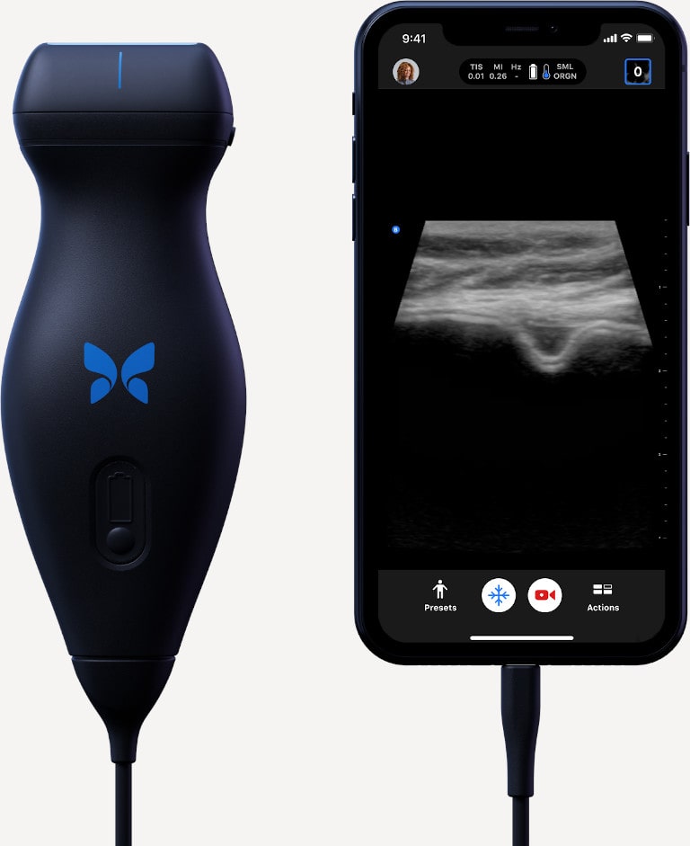 Butterfly Mobile Ultrasound